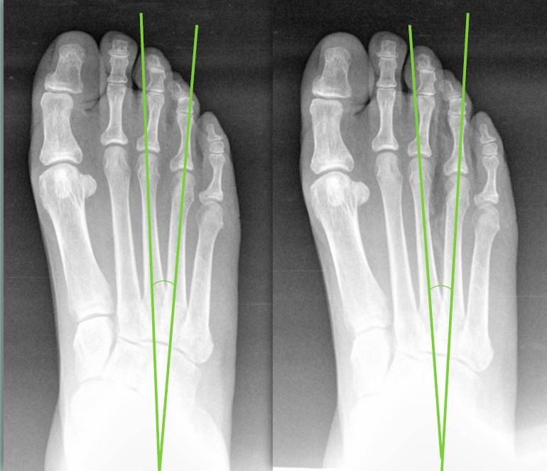 Deep Transverse Metatarsal Ligament Transection in Neuroma Surg